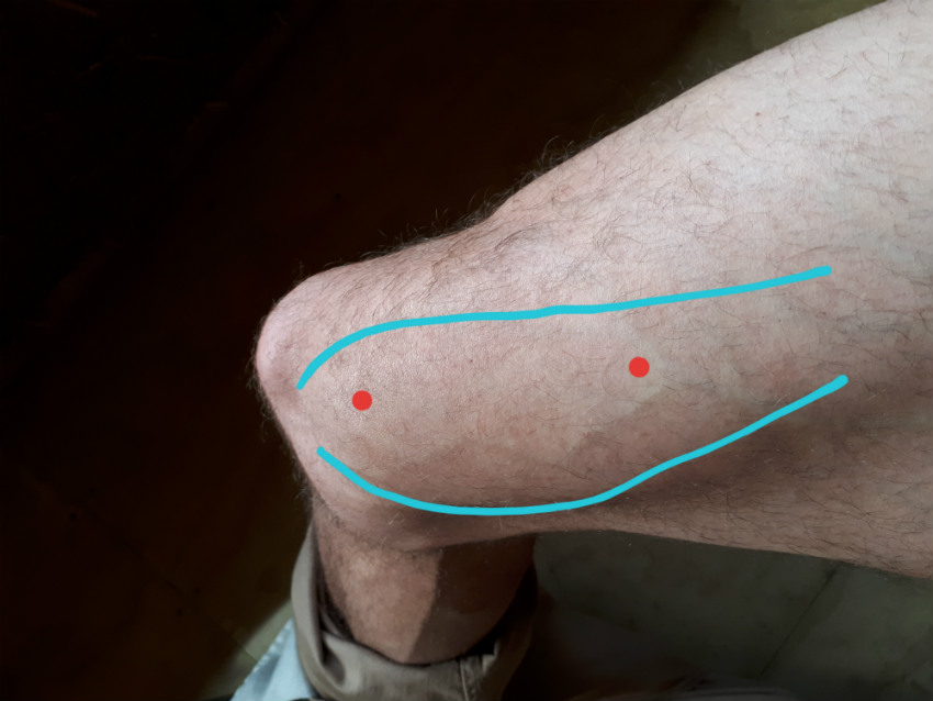 showing where the trigger points for inside knee pain are located