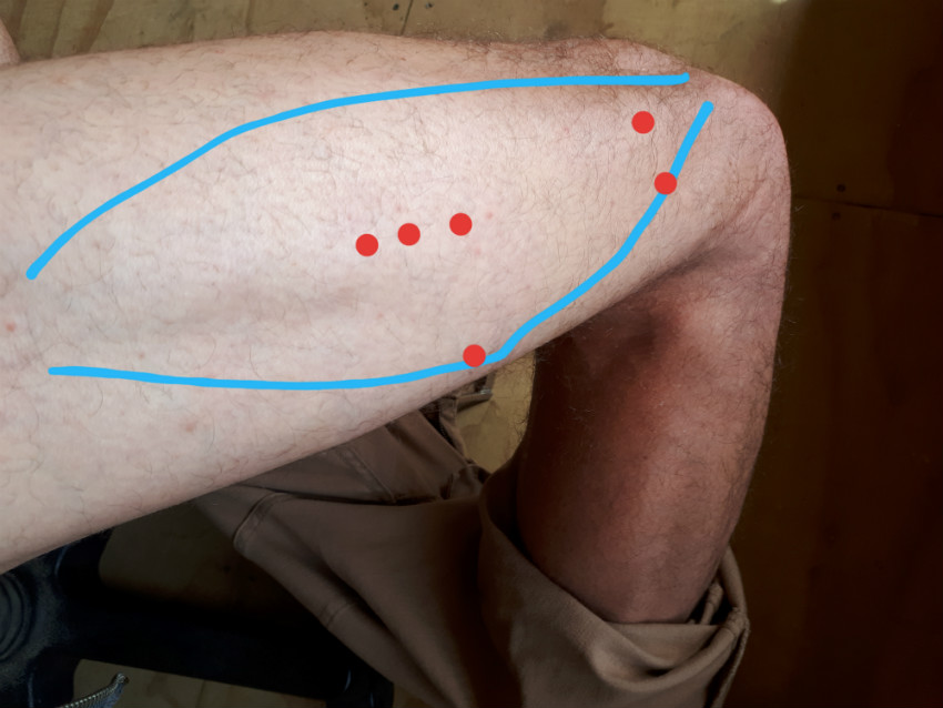 showing where the trigger points for outer knee pain are located